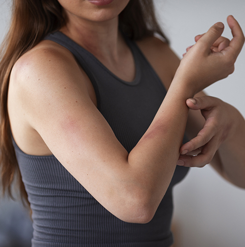 Atopic dermatitis