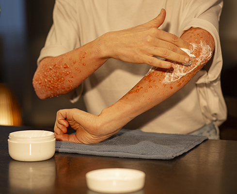 Psoriasis