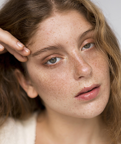 Acne